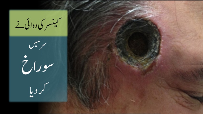 Man left with an inch wide HOLE in his head after using quack ointment to treat skin cancer  